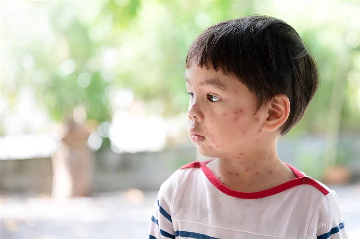 Cách chữa bệnh thủy đậu ở trẻ em an toàn cha mẹ nên biết