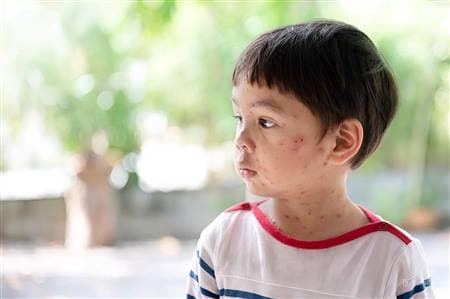Cách chữa bệnh thủy đậu ở trẻ em an toàn cha mẹ nên biết