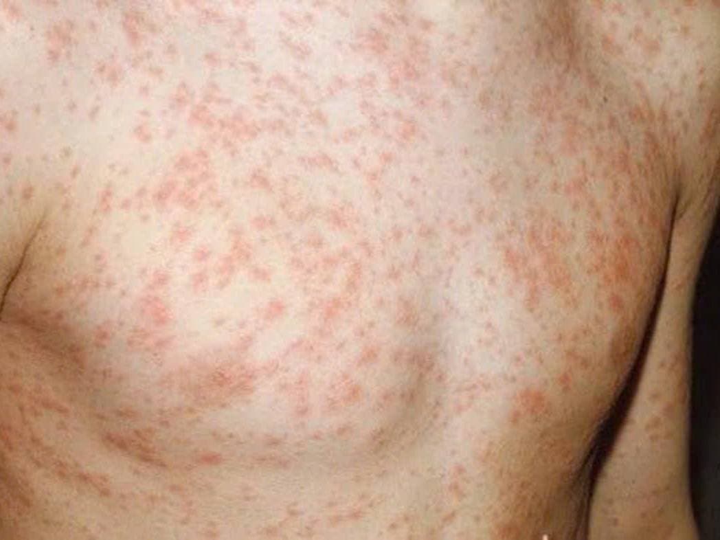 WHO KÊU GỌI HÀNH ĐỘNG KHẨN CẤP ỨNG PHÓ BỆNH SỞI