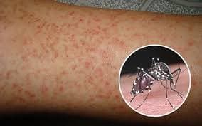 Đẩy mạnh các biện pháp tăng cường phòng chống Sốt xuất huyết Dengue