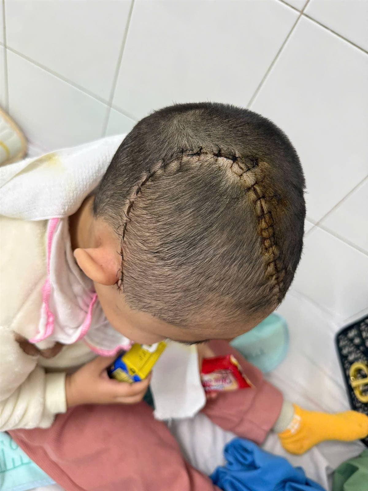Giành lại sự sống cho bệnh nhi 3 tuổi bị chấn thương sọ não nặng