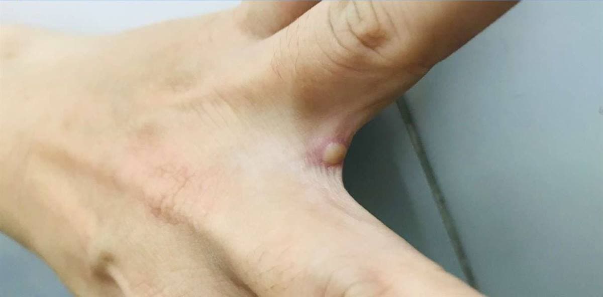 BỘ Y TẾ KHUYẾN CÁO PHÒNG CHỐNG BỆNH ĐẬU MÙA KHỈ