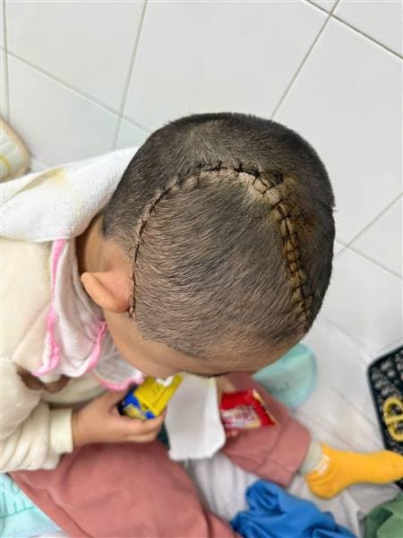 Giành lại sự sống cho bệnh nhi 3 tuổi bị chấn thương sọ não nặng